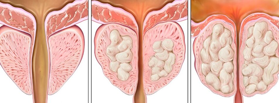Prostatit aşamaları
